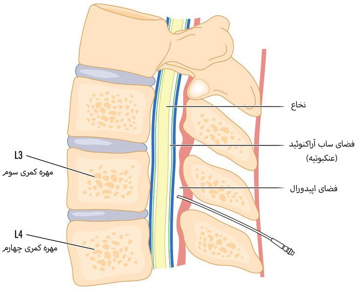 اهداف تزریق اپیدورال