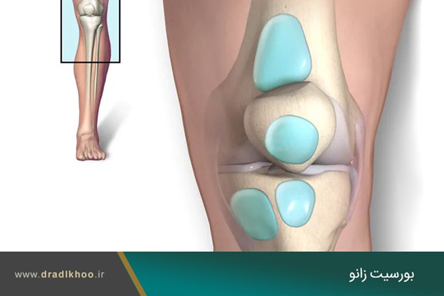 درمان بورسیت زانو با تزریق کورتیکواستروئید
