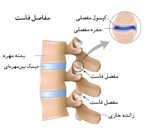 درمان سندروم مفاصل فاست
