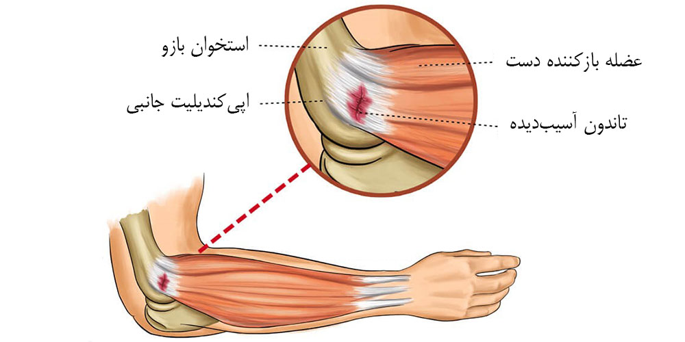 تنیس البو علائم 